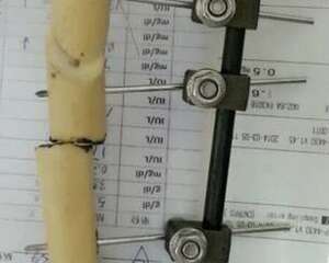 外固定支架在四肢骨骨折中的应用