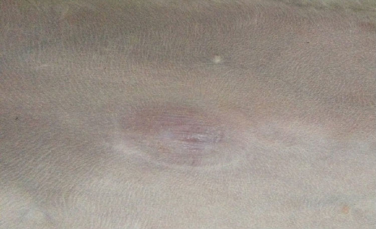 犬脐疝的诊断及手术方法