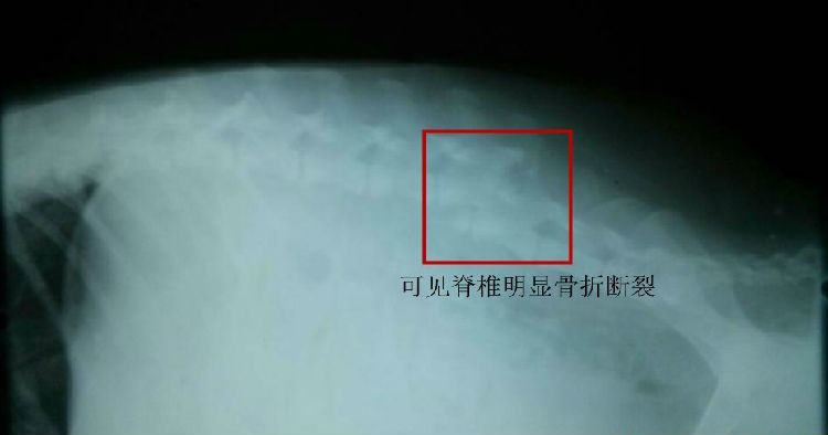 犬车祸后脊椎骨折的治疗