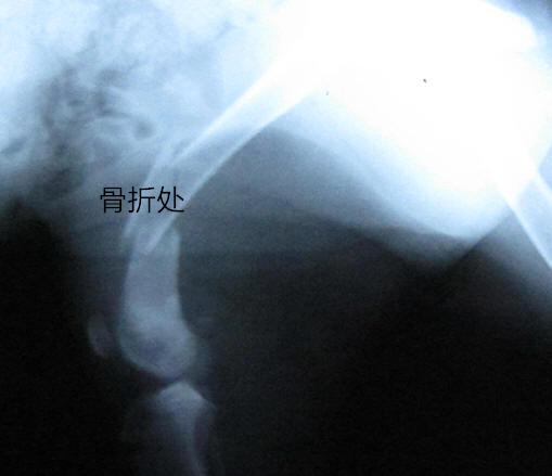 犬的肱骨骨折以及内固定