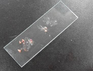皮肤病常见检查方法 皮肤病常见检查方法