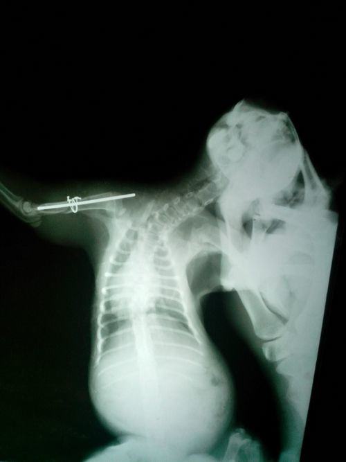 一例猫髓内针固定肱骨骨折及股骨骨折的手术案例