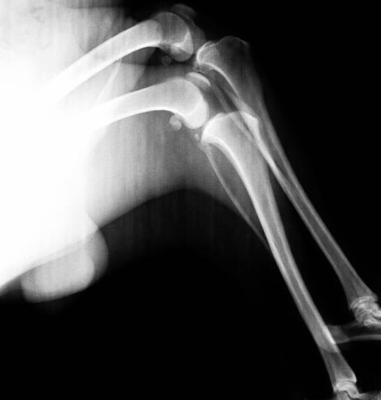 外固定支架在四肢骨骨折中的应用 外固定支架在四肢骨骨折中的应用